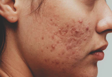 मुरूम / फोड Acne Or Pimple