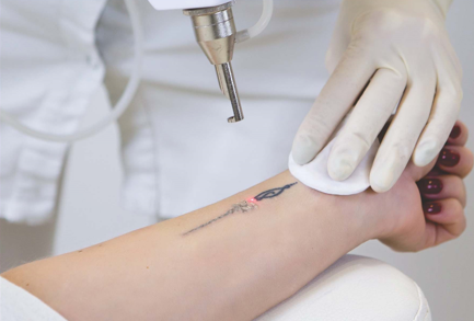 गोंधलेले टॅटू काढून टाकणे Tattoo Removal