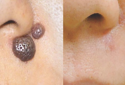 मस काढणे Mole Removal