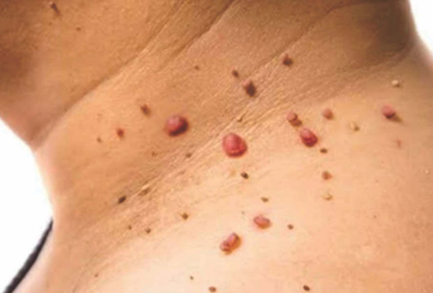 चामखीळ काढणे Wart Removal
