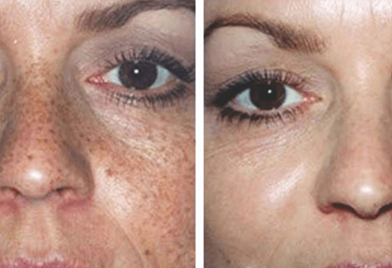 चेहऱ्यावरील तीळ काढणे Freckles Removal