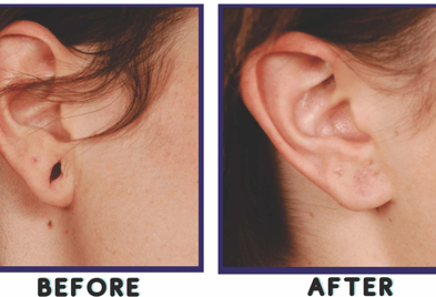 कानाचे वगळलेले छिद्र बुझवणे Ear Lobule Repair