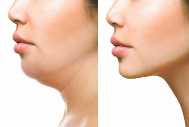 चेहऱ्याचे पुनरुजीवन Skin Rejuvenation Double Chin Removal