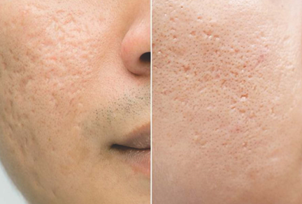 फोडांमुळे पडलेले डाग Acne Scar Treatment