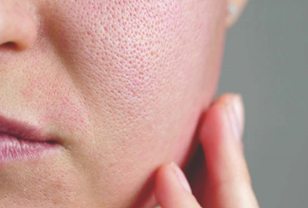 चेहऱ्यावरील खड्डे Open Pore Reduction