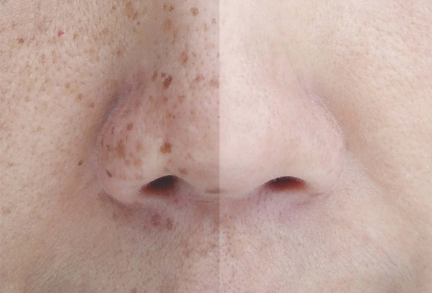 चेहन्यावरील डाग Black Spot, Sunburn Spot