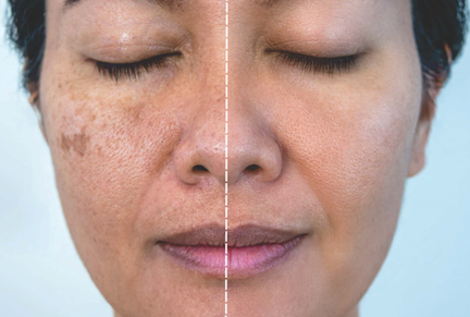 चेहऱ्यावरील वांग Melasma Treatment