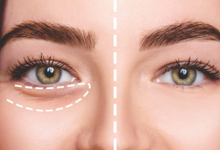 डोळ्याखालचा काळेपणा Under Eye Treatment